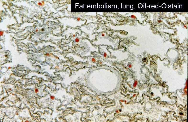 necrosis Fat embolism Liver rupture hemoabdomen
