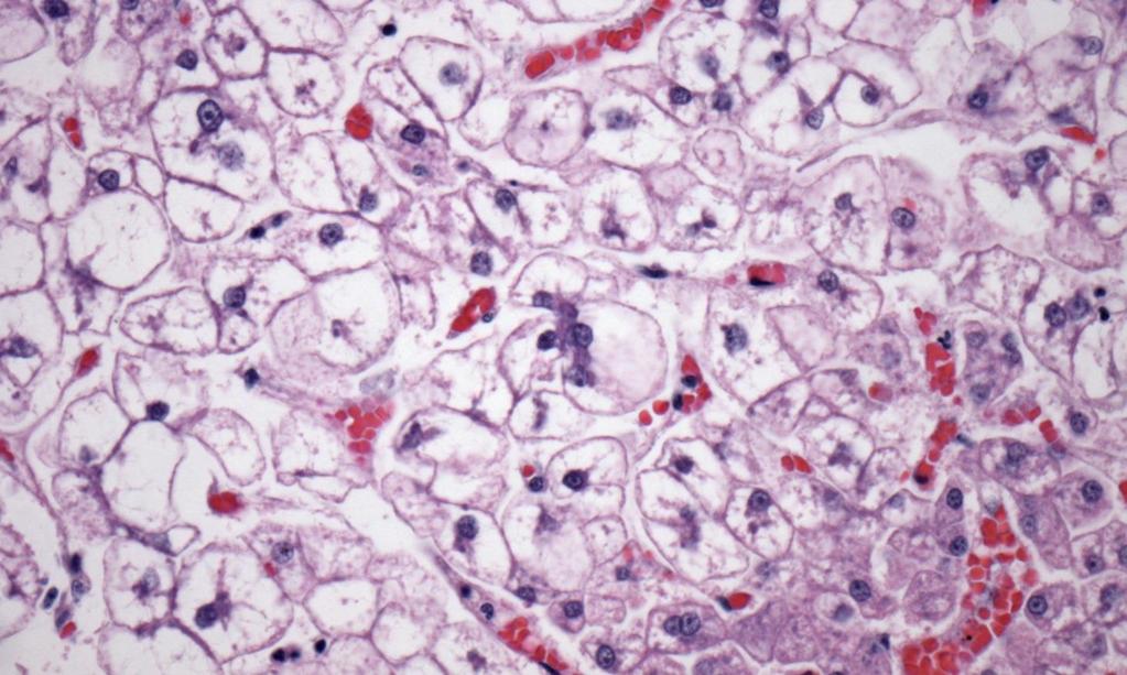 Enlarged, pale liver due to swollen hepatocytes