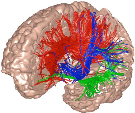 Diffusion Tensor Imaging MRI can detect and distinguish tracts in