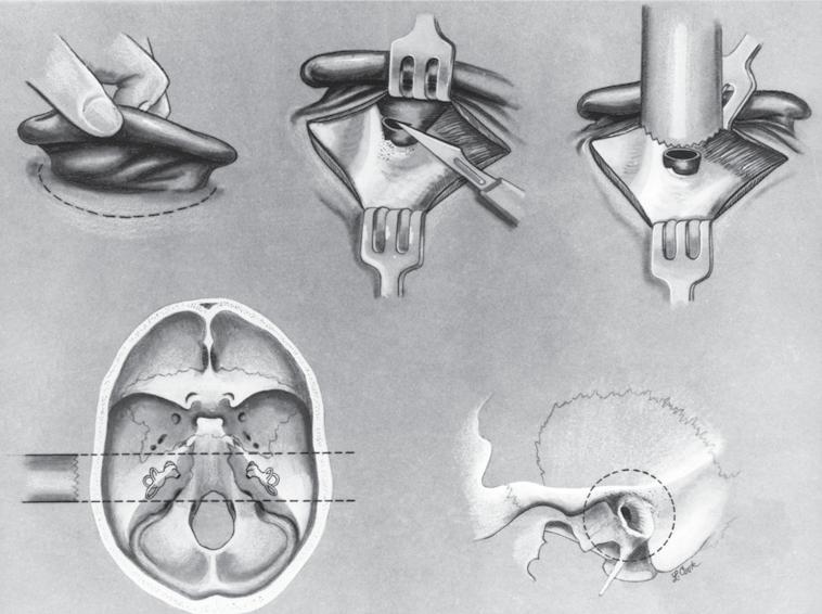 Extracranial Technique for Temporal Bone Removal Use this method if a brain autopsy cannot be done. This technique requires a special extracranial bone plug cutter, which is shown in Figure A.