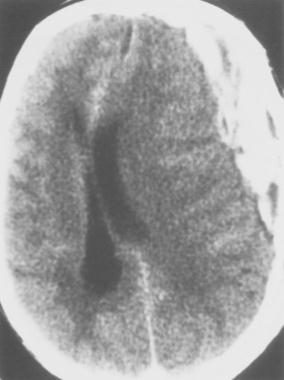 The low density may be secondary to unclotted blood or possibly CSF resulting from traumatic arachnoid tears.