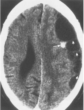 Figure 5: Large chronic subdural hematoma overlies the left cerebral convexity. The hyperdense area represents recurrent hemorrhage (long arrow).
