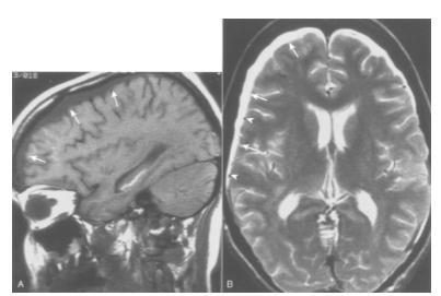 Figure 8: Right frontal convexity chronic subdural hematoma is slightly hyperintense on sagittal T1-weighted (500/15) (A) and isointense on axial T2-weighted (2500/80) (B) MR images relative to