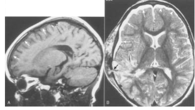 Figure 9: Same case as in Figure 6. Sagittal T1-weighted (500/15) (A) and axial FSE T2weighted (3500/108) (B) MR images show cerebrospinal fluid hygroma over right hemispheric convexity (arrows).