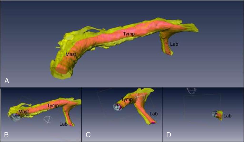 516 M. VIANNA ET AL. FIGURE 2. A, Three-dimensional model of the facial nerve (pink) and facial canal (yellow).