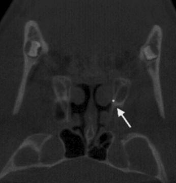 (XZ) Medial pterygoid A thin plate