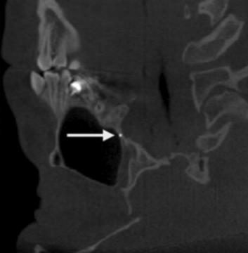 Lateral pterygoid A plate forming the