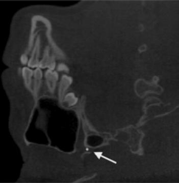 The landmark is seen in a coronal plane, located lateral to the sphenoid sinus.