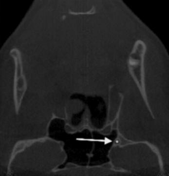 medial pterygoid plate, connecting into the pterygopalatine fossa.