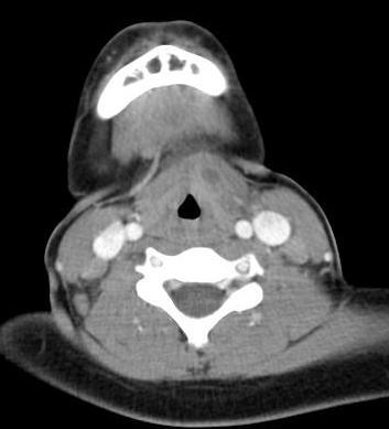the axial CT images, which