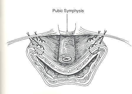 Retro-pubic Urethropexy / Colposuspension Marshall-Marchetti-Krantz 1949 Burch 1961 Permanent suture 2-3 per side