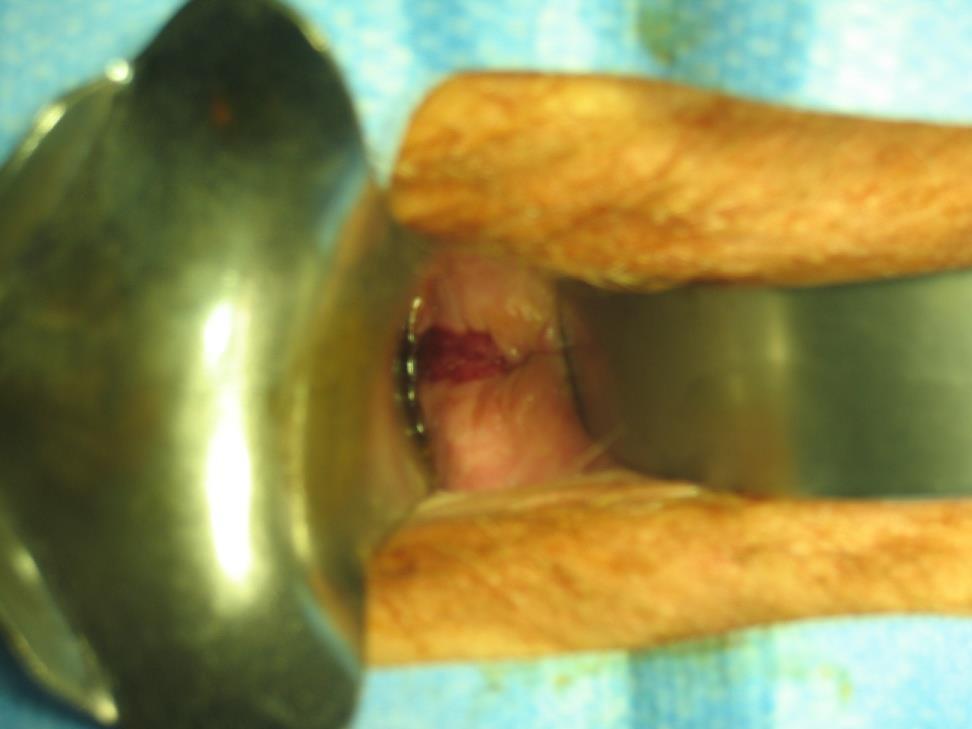 Female Urinary Incontinence Bypass of anatomic continence mechanism Fistula Vesicovaginal Urethrovaginal Vesicouterine Diverticulum- urethral