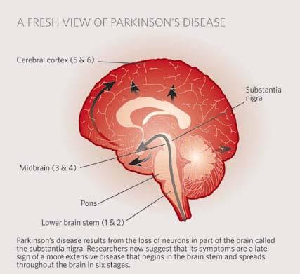 SLEEP Hypocretin cell loss (38-45% decline) in PD impacts sleep/wakeful cycles Predate Parkinson s diagnosis?