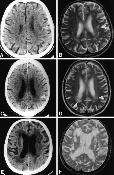 The European Task Force on Age-related white matter changes (ARWMC) Score 1: Focal