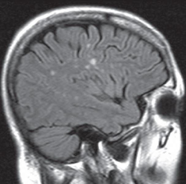 and white matter atrophy, probably related to