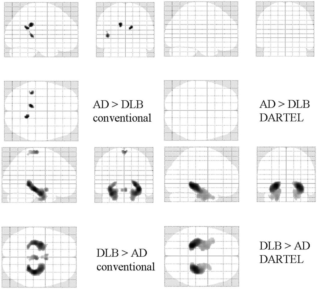 Fig 2. Statistical parametric maps comparing the brains of patients with DLB with those with AD. Comparisons based on conventional VBM (left) and VBM-DARTEL (right) are both illustrated.