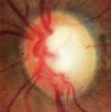 Optic Neuritis Chronic clinical features 10 years: 20/20 in 74%, 20/25 to 20/40 in 18%, 20/40 to 20/200 in 5% Afferent pupillary defect: ¼ in 2 years