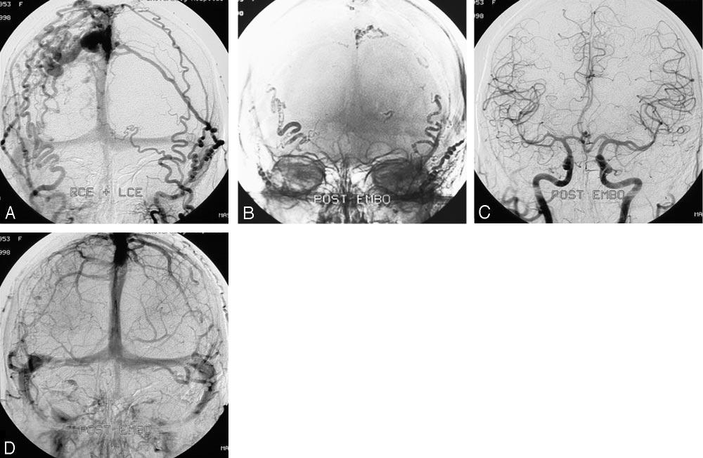 Fig 1. A 43-year-old man with an incidentally discovered tentorial dural fistula.