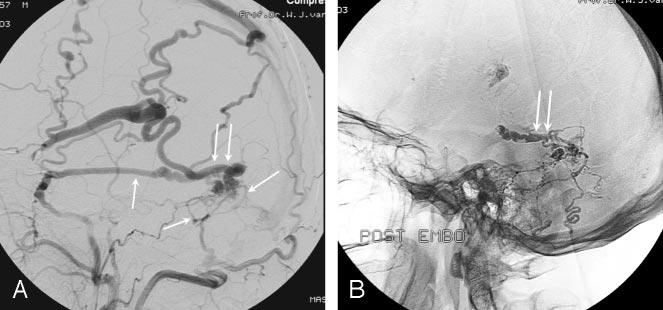 Fig 3. A 43-year-old woman presenting with a left parietal hematoma.