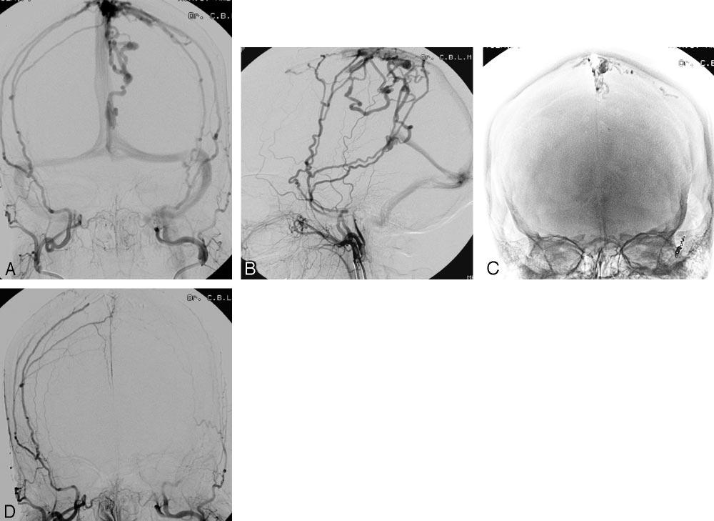 and subsequently into the superior sagittal sinus and deep venous system. C, Glue cast after embolization shows occlusion of the draining veins.
