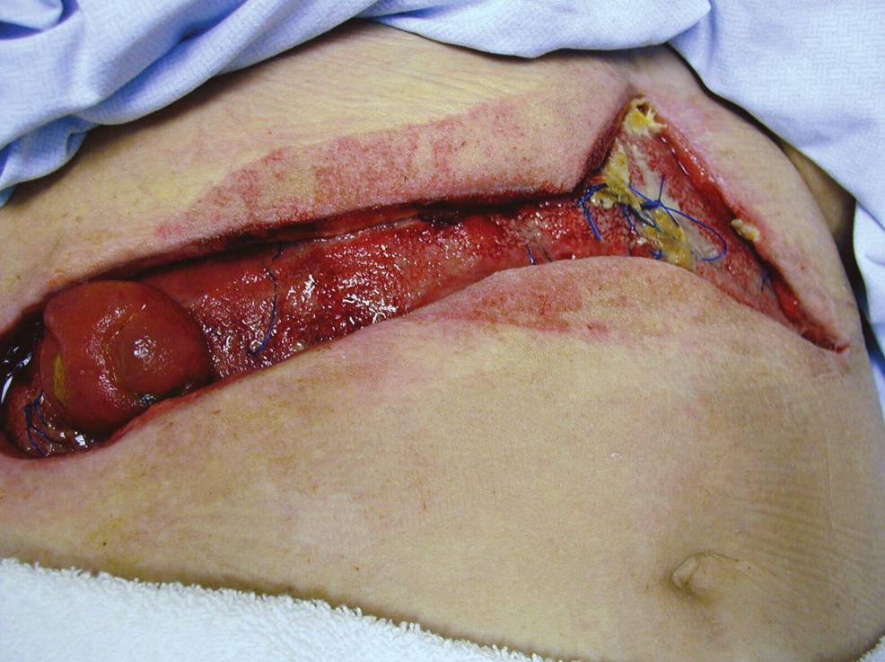 60-66_OWM0406_Reed.qxd 3/30/06 3:16 PM Page 62 Figure 1. A colocutaneous fistula within a wound. Figure 2. Open cell foam dressing cut to fit the wound and fistula. Figure 3.