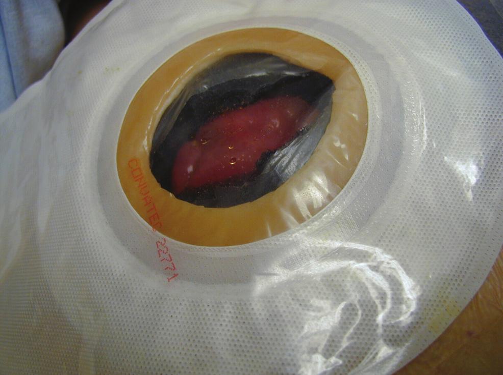 Figure 7. The pouching system is placed over the fistula and attached to the transparent dressing. attaching the adhesive backing to the surface of the transparent dressing (see Figure 7).