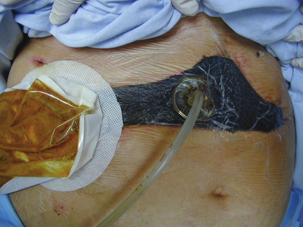 As negative pressure was applied, the fistula was observed for visibility and the dressing was assessed for occlusion.
