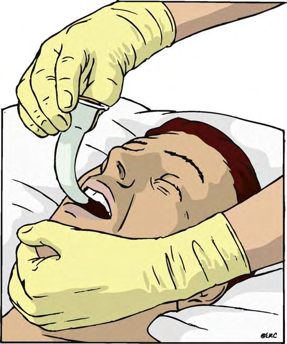 helpful, and sometimes essential, to maintain an open airway, particularly when resuscitation is prolonged. The position of the head and neck must be maintained to keep the airway aligned.