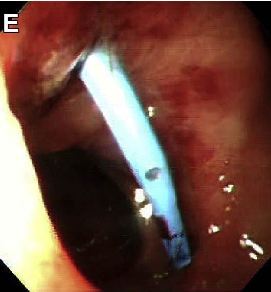 Post pancreatitis collection/fistula Intervene for symptomatic or complicated collections EUS