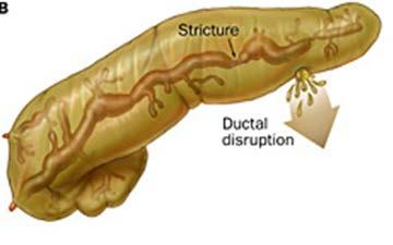 continuity and side-branch leak present ductal stricture can be traversed External drainage if