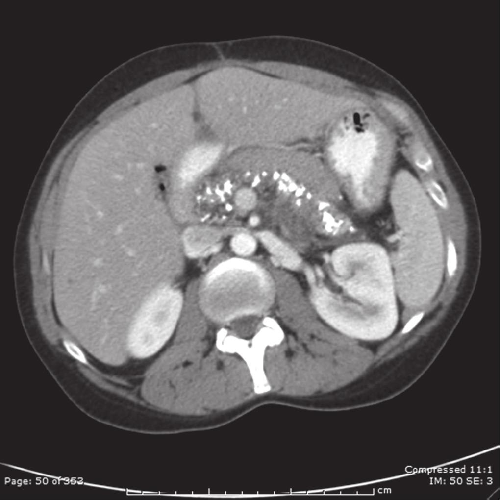 Chronic pancreatitis is classified based on the Cambridge criteria: 8 1. Mild >3 abnormal side branches 2. Moderate Inclusion of abnormalities of the main pancreatic duct 3.
