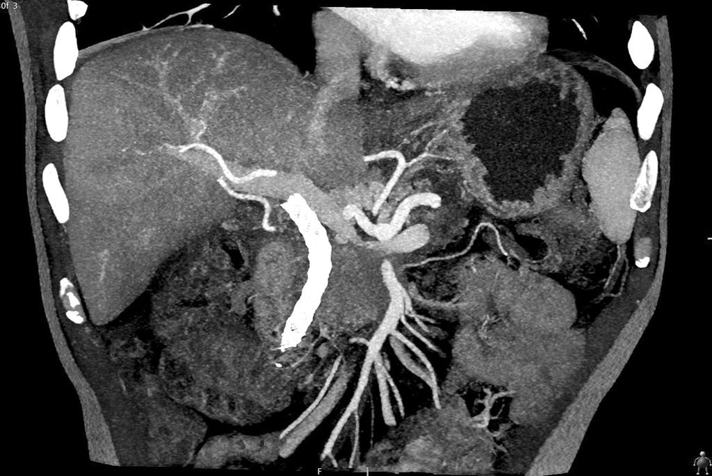 102 Ann Hepatobiliary Pancreat Surg Vol. 21, No. 2, May 2017 Fig. 1. Computed tomography image showing porto-mesenteric venous stenosis and metallic stent for biliary obstruction. Fig. 3.