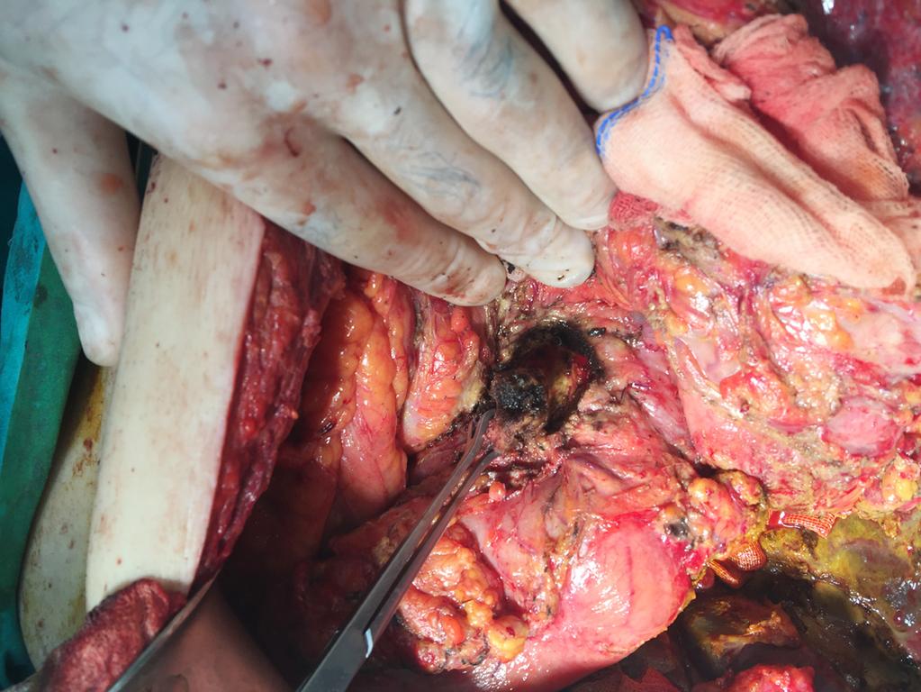 Cuneyt Kayaalp, et al. Pancreatic head resection in case of venous collaterals Fig. 4. Operative photograph showing excavation of pancreatic head.
