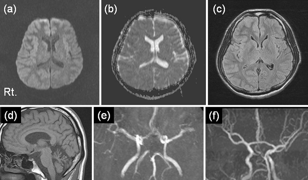 Intern Med 53: 2245-2250, 2014 Figure 1. Brain MRI performed at the first admission. (a) DWI showing swelling in the right cortical hemisphere.