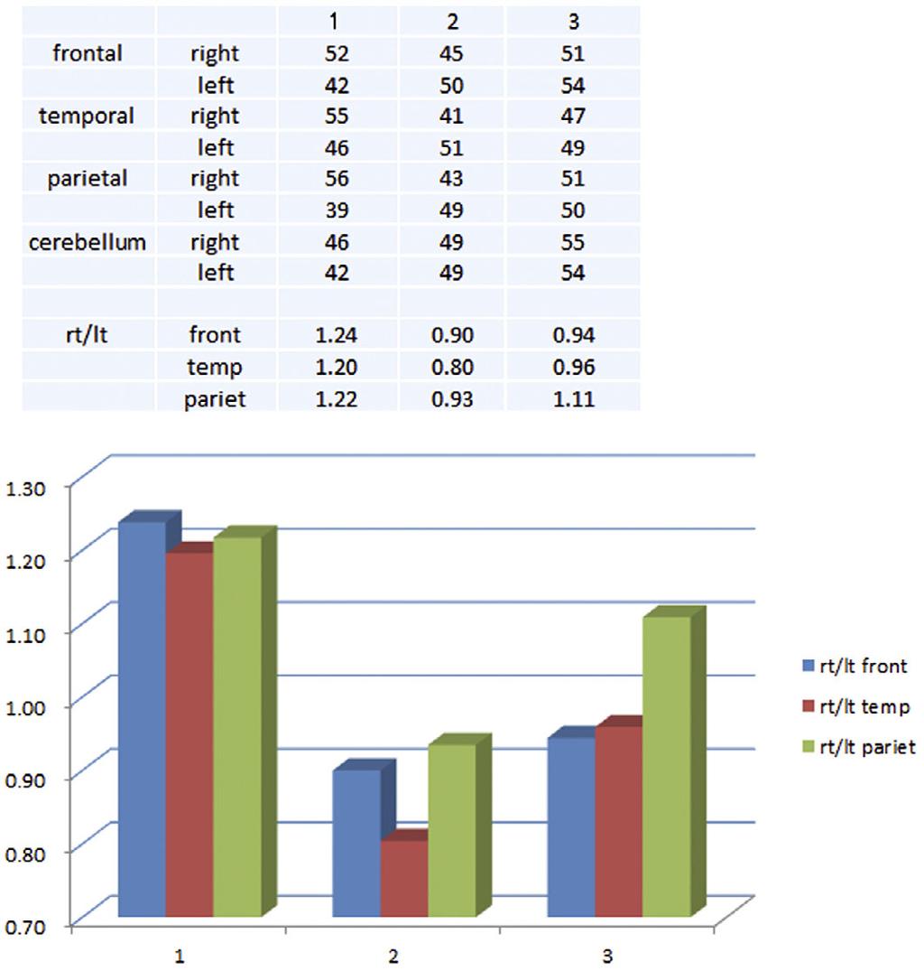 Intern Med 53: 2245-2250, 2014 Figure 5. Regional blood flow on ECD-SPECT (Patlak Plot method).