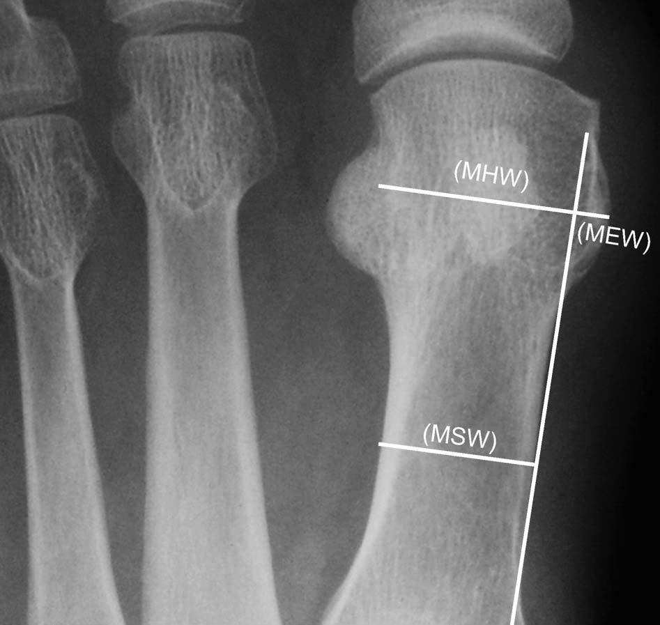 Methods Anteroposterior weightbearing radiographs from 200 patients were reviewed.