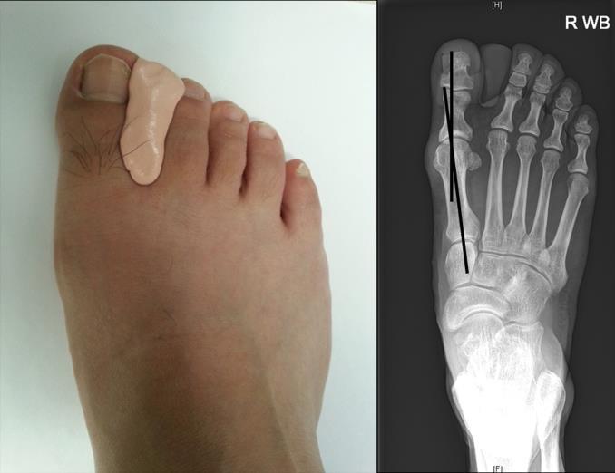 on his left foot, one patient had hallux valgus on the right foot, and 6 patients had hallux valgus on both feet. All patients had bunions on the first metatarsal head.