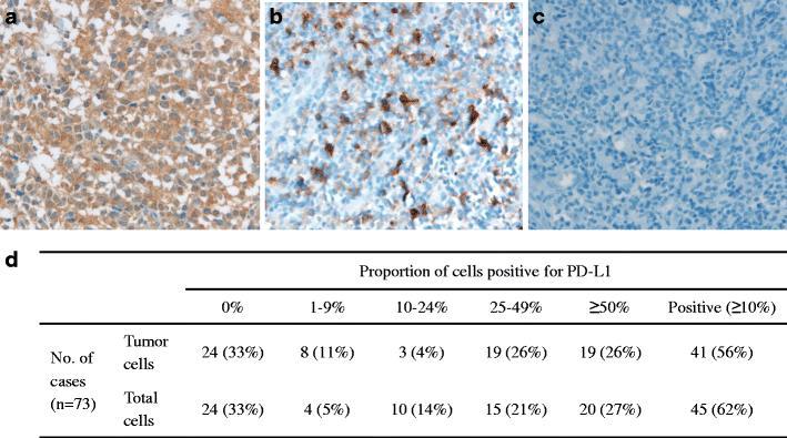 Expression of PD-L1 in advanced stage ENK/T cell lymphoma is associated with better prognosis (N=73) PD-L1 positivity showed no relationship with clinicopathological