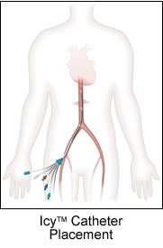 Endovascular Catheters Challenges with cooling: Obese patients (Adipose insulates 3x s as well as