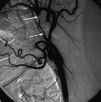ICA Dissection on Conventional Angiography The gold standard imaging modality String sign: long, tapered, eccentric and irregular stenosis that begins