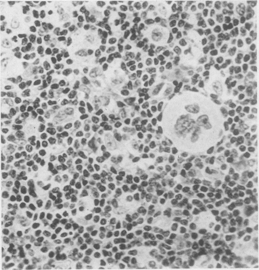 2 The presence of abnormal reticulum cells among which were cells considered to be specific for nodular sclerosis (Fig. 2). The presence of fibrosis found very often around blood vessels (Fig.