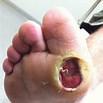 2-4 times/week Obstacles preventing wound Patient is not able or willing to wear protective or diabetic foot wear, diabetes is not well controlled, is not able or willing to keep scheduled