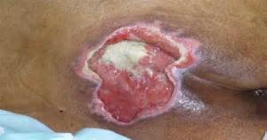 *If slough is present the wound must be classified as a Stage III* dressing of choice, or Restore hydrocolloid, thick or thin. (shoes/cushions/mattress).