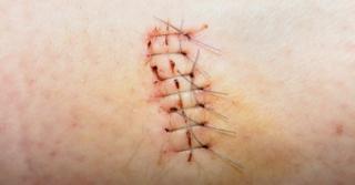 Surgical Is the result of an incision made with a cutting instrument during a sterile procedure. Intact Edges are approximated with sutures, staples, or adhesive.