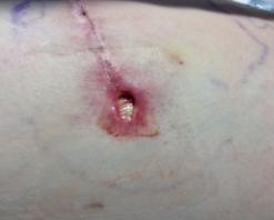 Dehisced (visible wound bed) Edges are open as a result of poor surgical techniques, strenous activity, infection, smoking, comorbidities (diabetes, obesity, renal insufficiency).