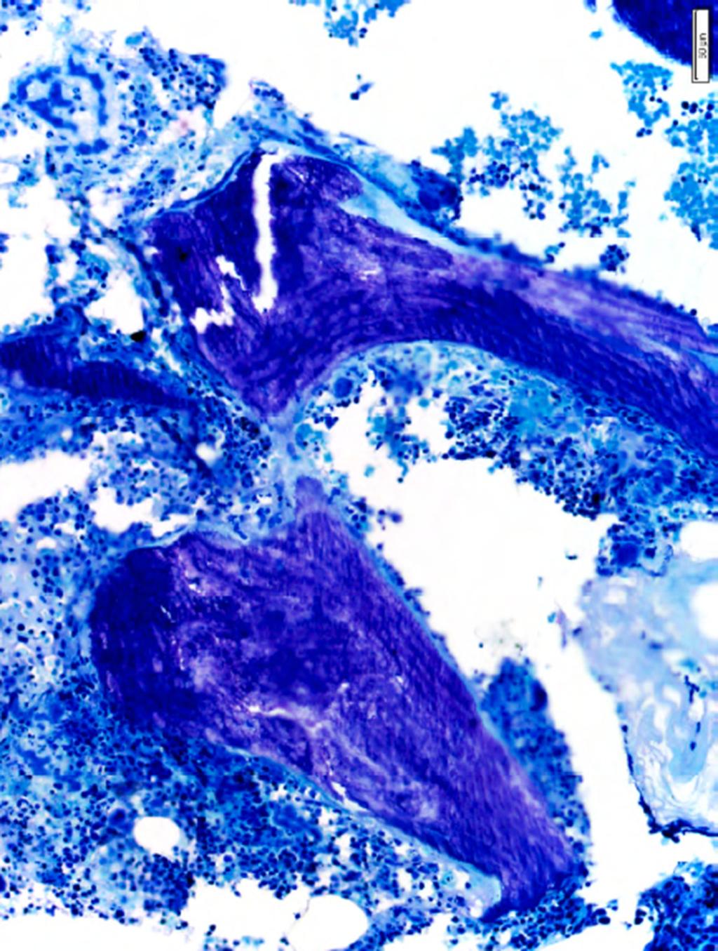 doi: 10.1210/er.2015-1105 press.endocrine.org/journal/edrv 333 Figure 8. Figure 8. Bone biopsy of a male patient with thalassemia major.