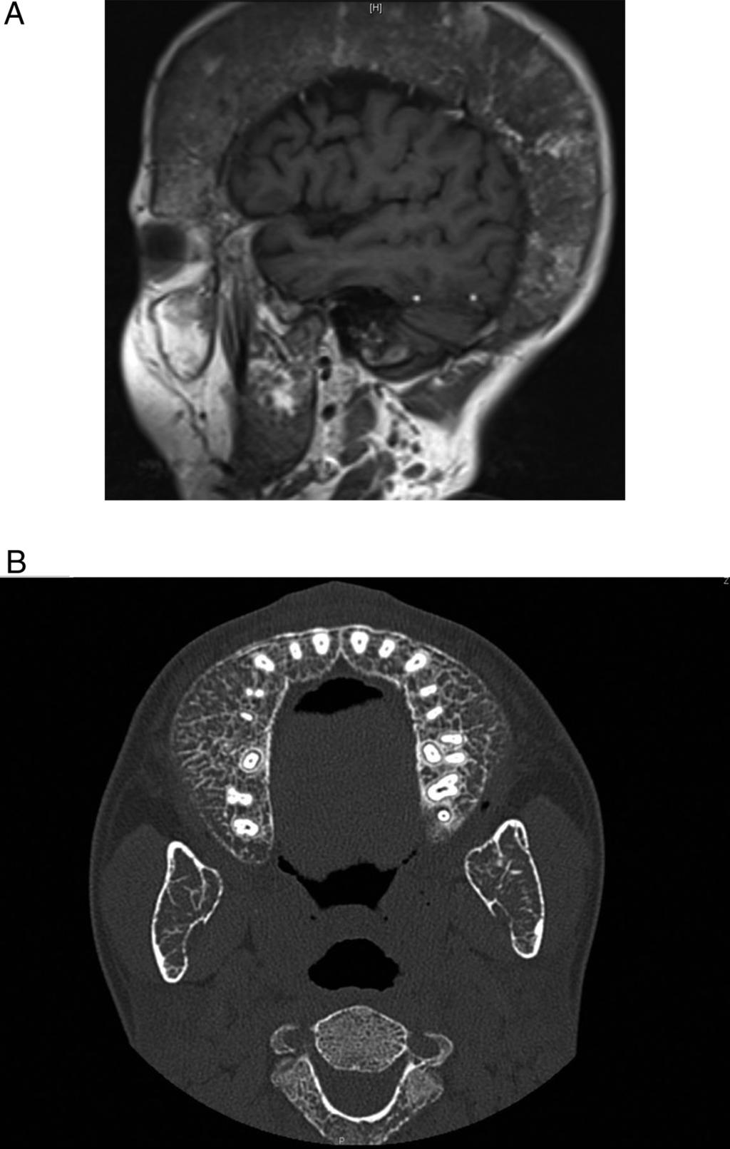 336 Wong et al Bone Disease in Thalassemia Endocrine Reviews, August 2016, 37(4):320 346 Figure 9. Figure 9. Bone deformity due to severe medullary expansion.