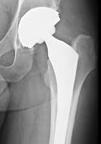 Prophylaxis in Hip and Knee Arthroplasty start postop Admit OR Discharge or rehab