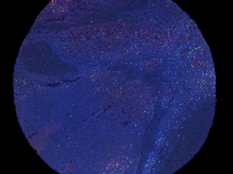 Melanoma TMA core: multiplexed labeling, conventional imaging