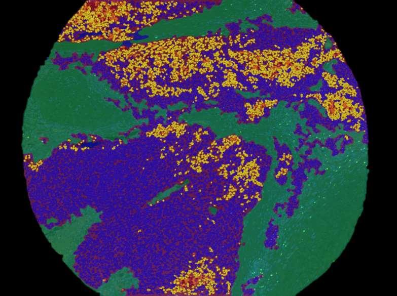 Melanoma TMA core with multiplexed immunofluorescence staining Per-cell intensity quantitation Tissue Unmixed Conventional segmentation: composite: Image PD-L1 Tumor 0-3+